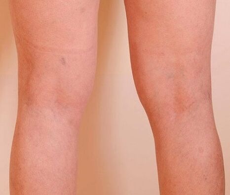 Varicone got rid of varicose veins