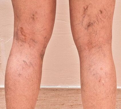 Varicose veins appeared on my legs