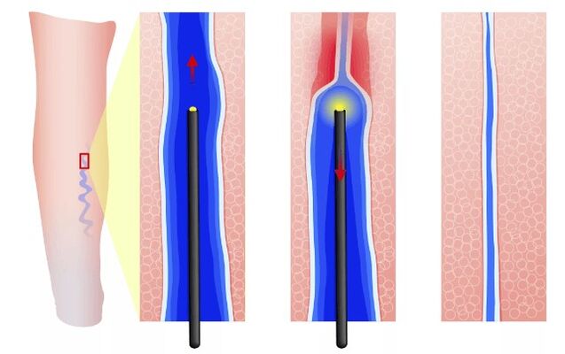 Endovasal electrocoagulation