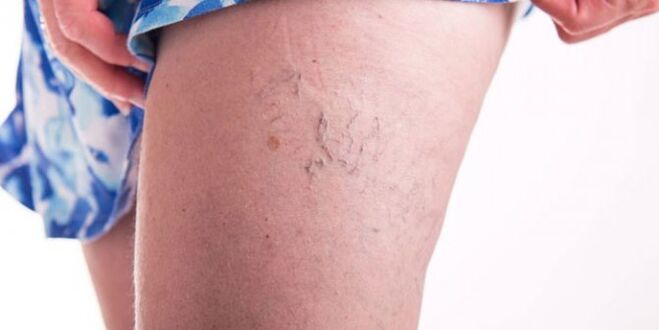 Varicose veins on the leg
