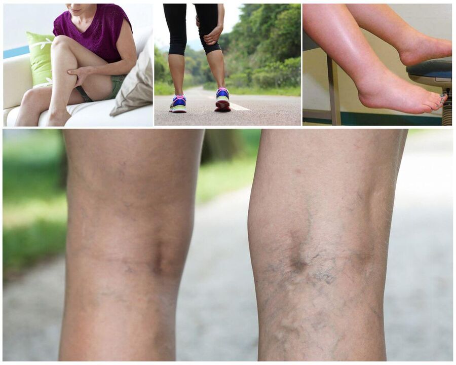 Start Varicosis