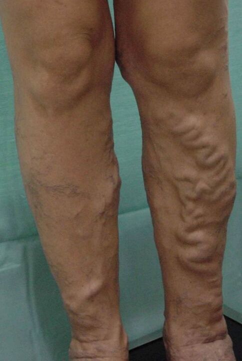 Varicose veins on the legs