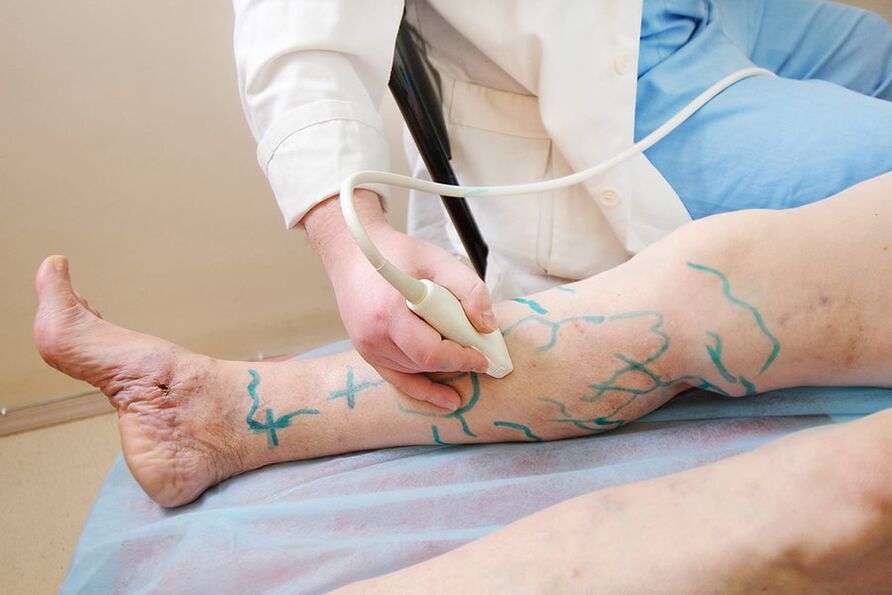 Preparation for miniphlebectomy marking of leg perforators, performing an ultrasound