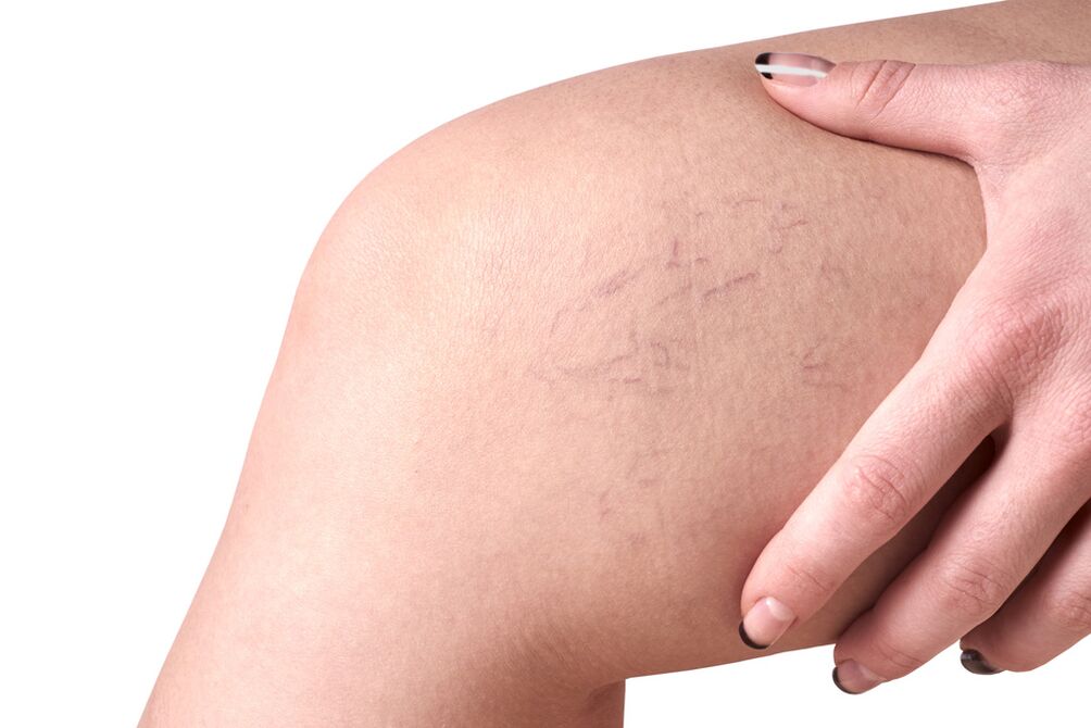 Stage C1 – varicose veins