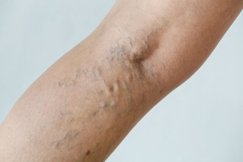 Stage C2 – popliteal varicose veins (Thierry perforators) and reticular veins