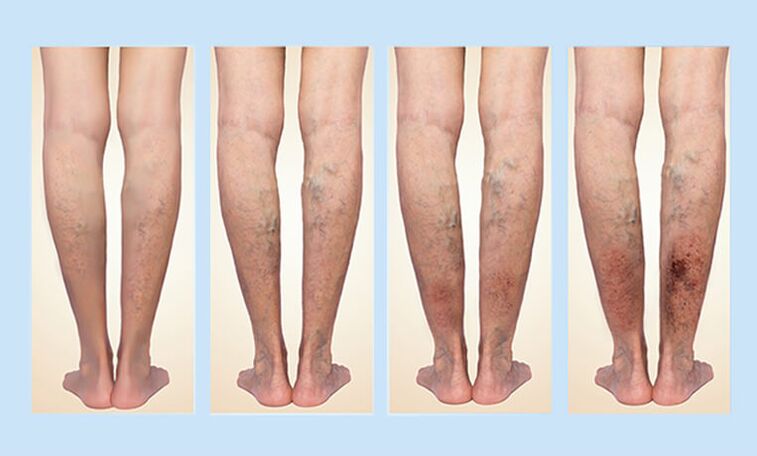 Phase of varicose veins