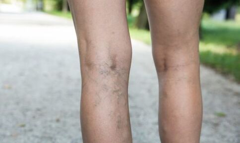 the appearance of varicose veins, a symptom of varicose veins